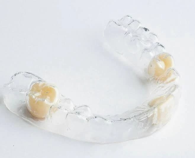 Clear Orthodontic Retainer