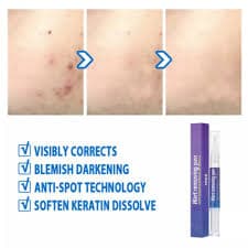 Unisex 12 Hours Wart Remover Pen Skin Tag Mole Remover Eliminate Foot Corn Warts | eBay