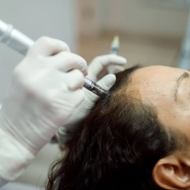 Microneedling Scalp Treatment - SkinPen