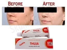 2 x SBL THUJA OINTMENT WART FUNGAL OVERGROWTH DRY SKIN & ERUPTION FRECKLES 2026 | eBay
